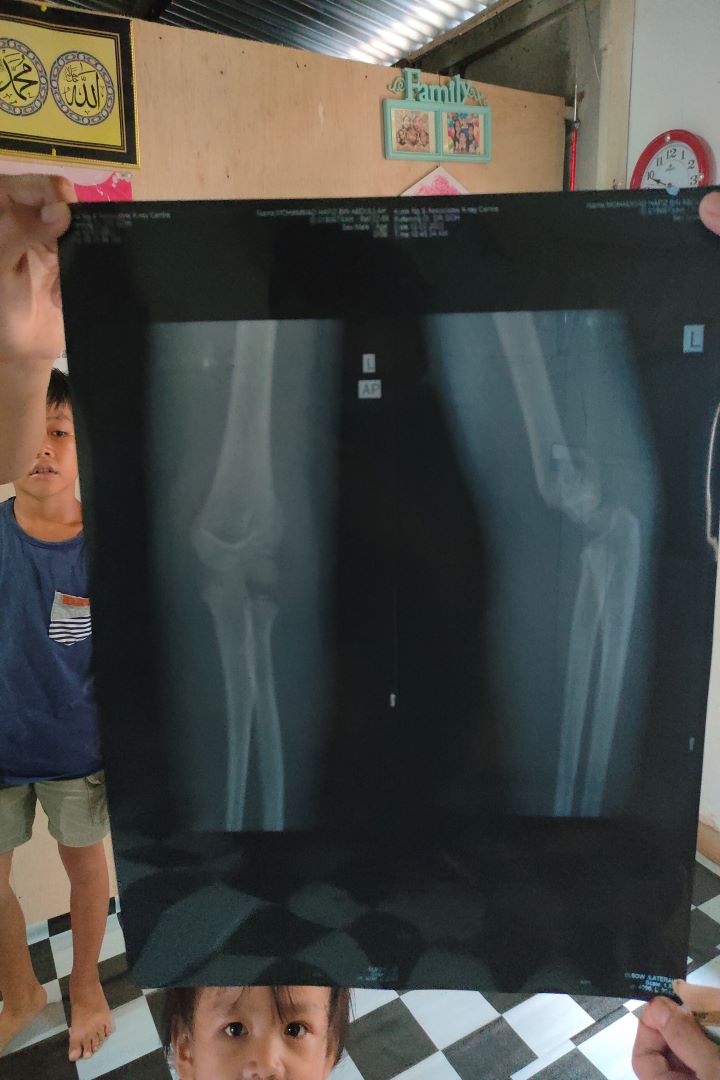 婼尔向邻居借了一百五十零吉，为儿子照X光。 X光片显示骨折。【摄影：郑应扬】